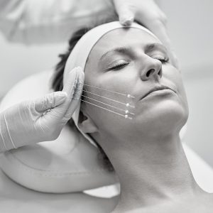 Qué es el tratamiento de lifting facial con hilos tensores del Doctor Oriol Vernetta, médico estético de Barcelona