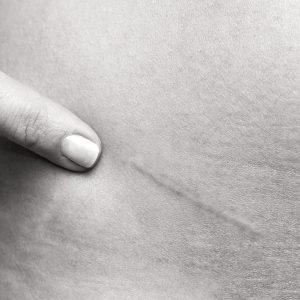 Todo lo que debes saber sobre los factores del paciente frente a las cicatrices por el Doctor Oriol Vernetta en la ciudad de Barcelona