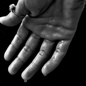 En qué consiste el tratamiento con neuromoduladores para la hiperhidrosis del Doctor Oriol Vernetta en Barcelona